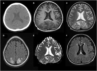 Childhood Posterior Reversible Encephalopathy Syndrome: Clinicoradiological Characteristics, Managements, and Outcome